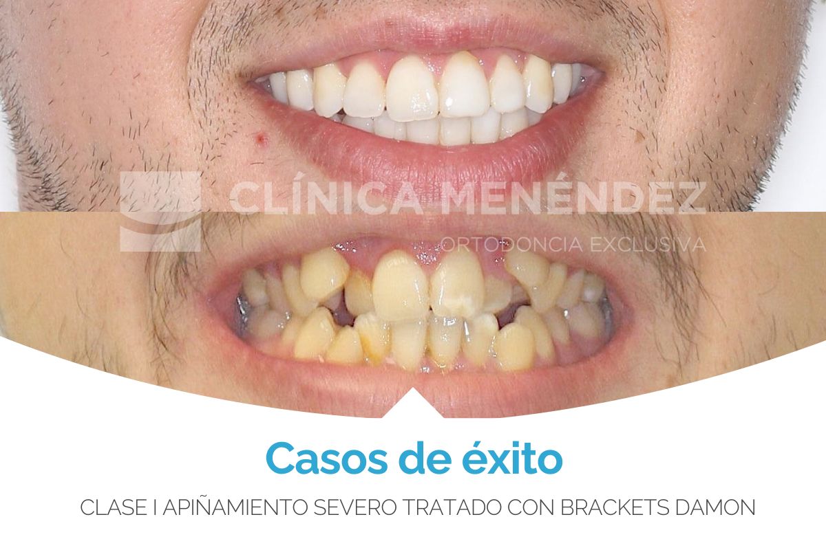 Clase I Apiñamiento severo tratado con brackets Damon