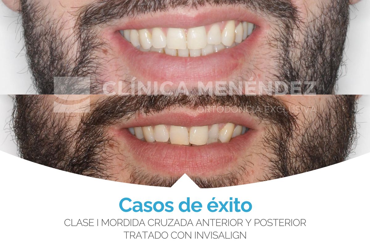 Clase I Mordida cruzada anterior y posterior tratado con Invisalign