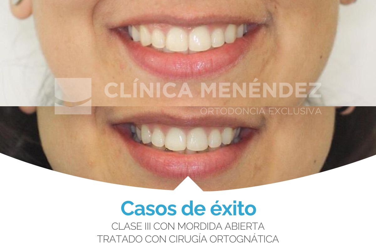 Clase I con apiñamiento tratada con brackets de Zafiro