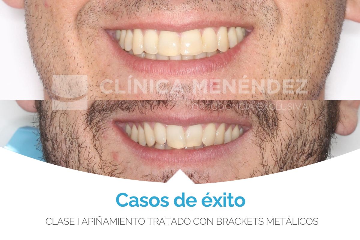 Clase I con apiñamiento tratado con brackets metálicos