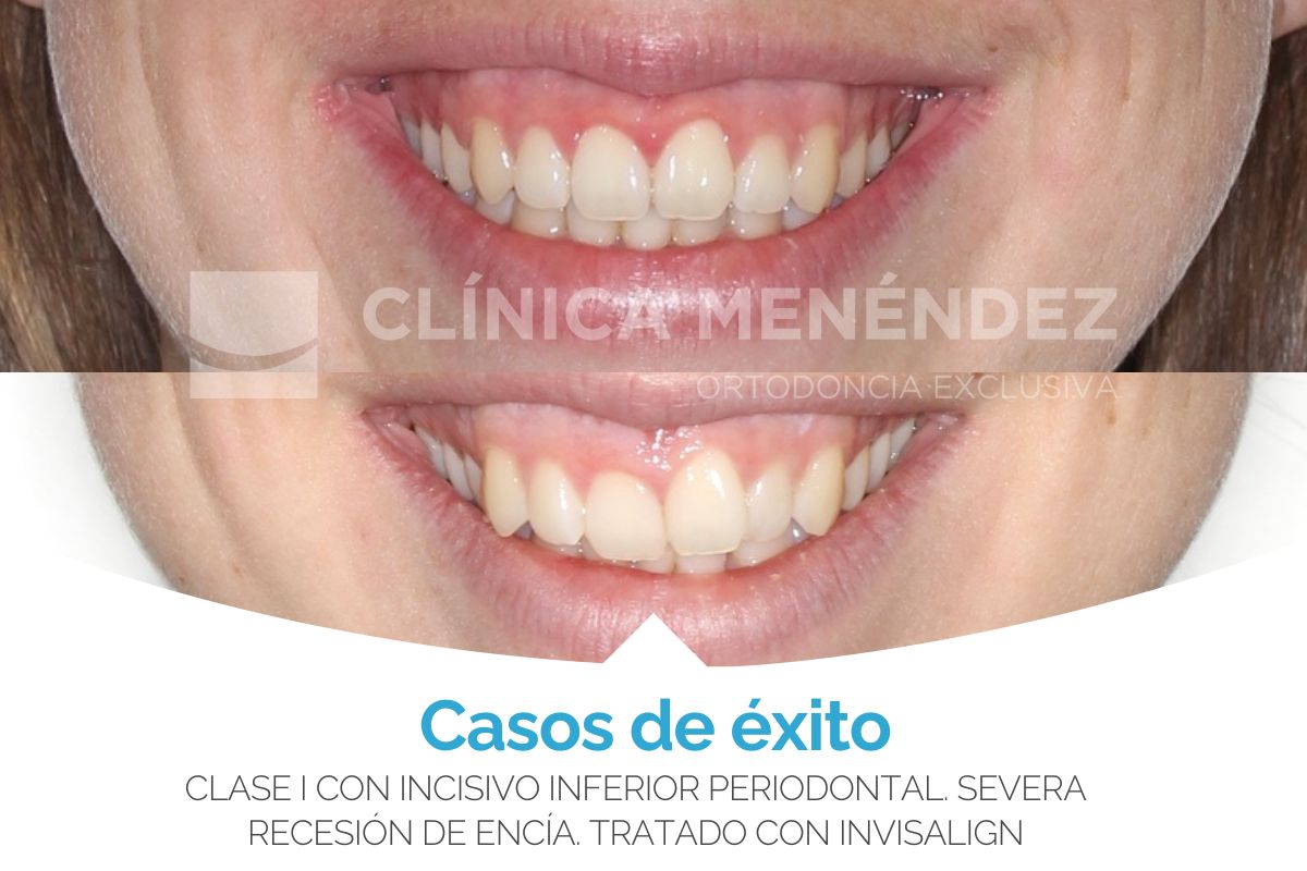 Clase I con incisivo inferior periodontal severa encía tratado con brackets metálicos