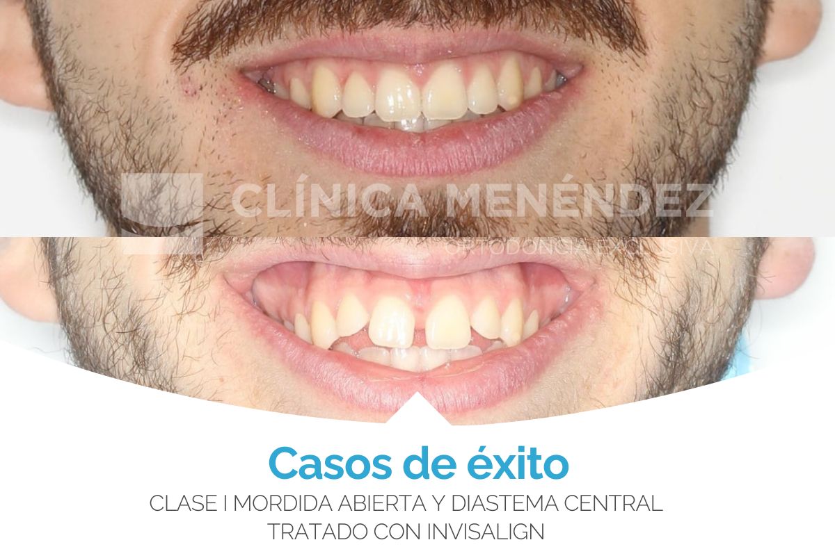 Clase I mordida abierta y diastema central tratado con Invisalign