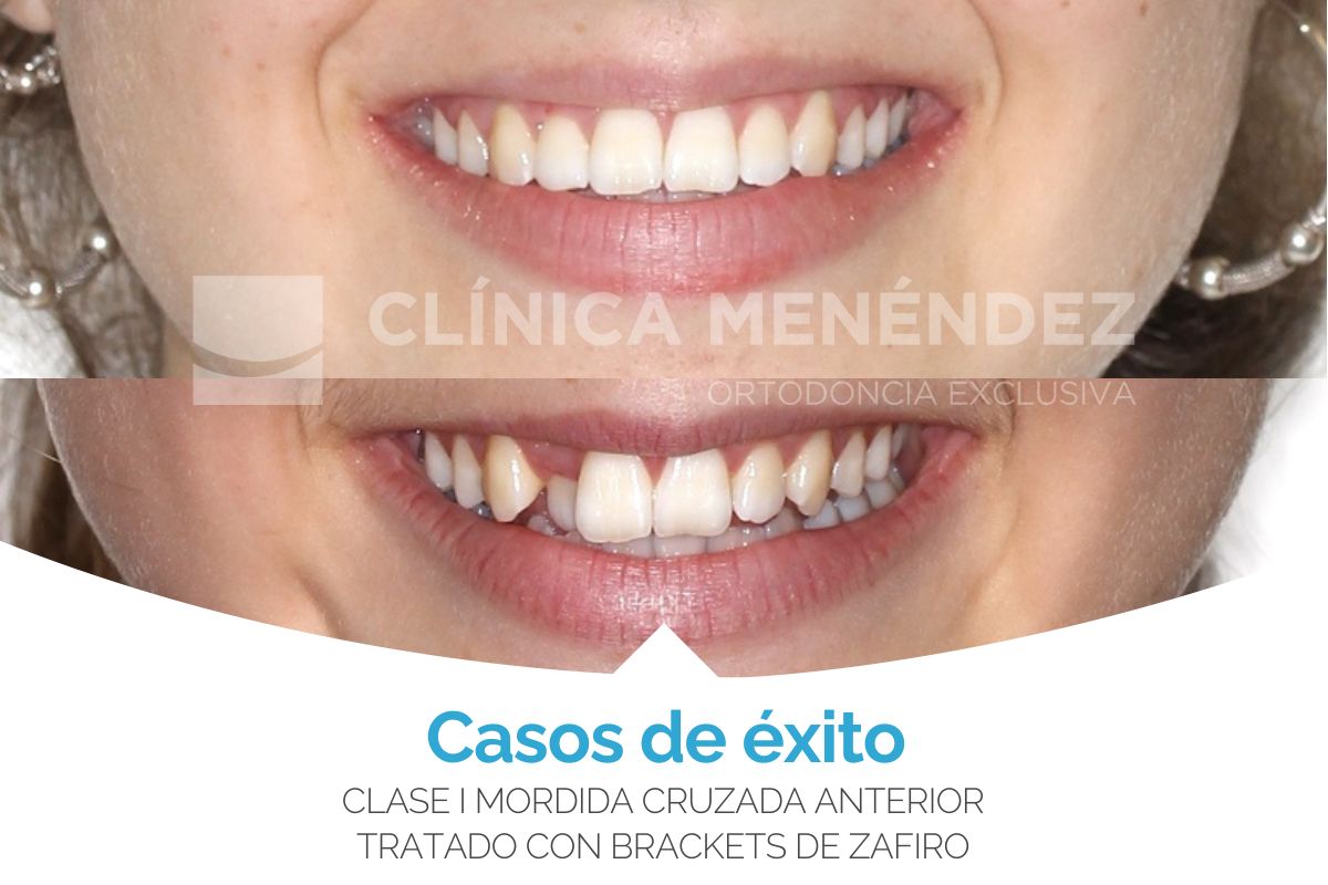 Clase I mordida cruzada anterior tratado con brackets Zafiro