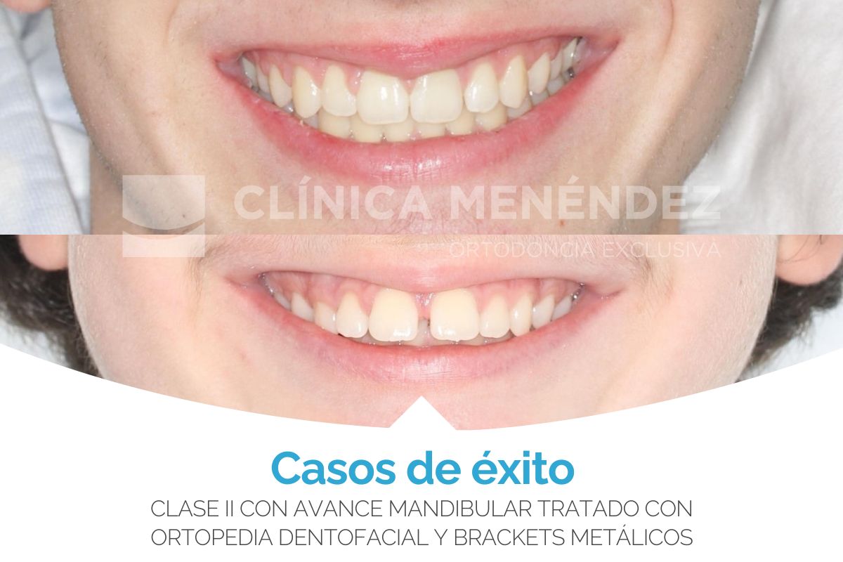 Clase II con avance mandibular – tratado con ortopedia dentofacial + brackets metálicos en niño