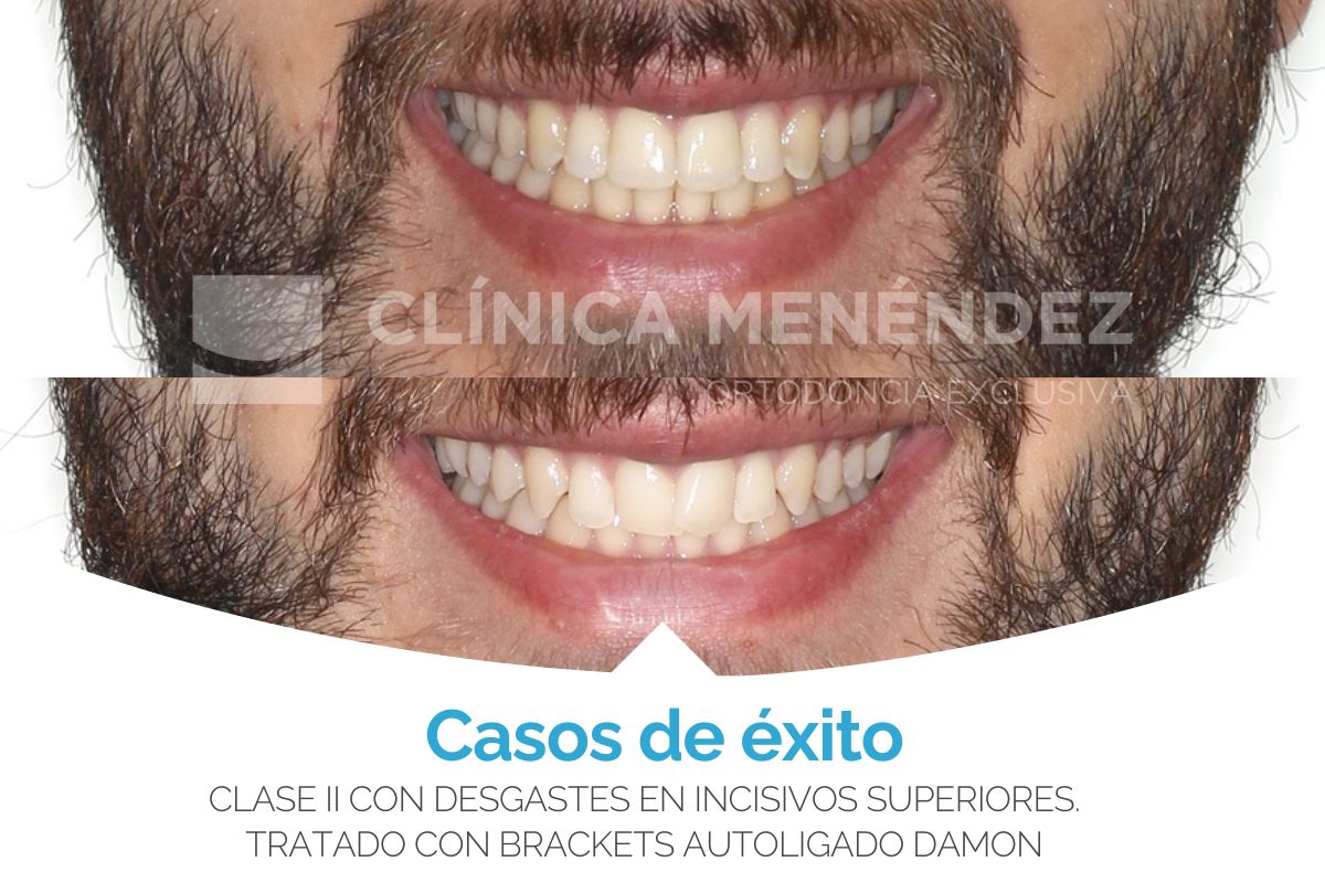 Clase II con desgastes en incisivos superiores tratado con brackets autoligado Damon + estética dental