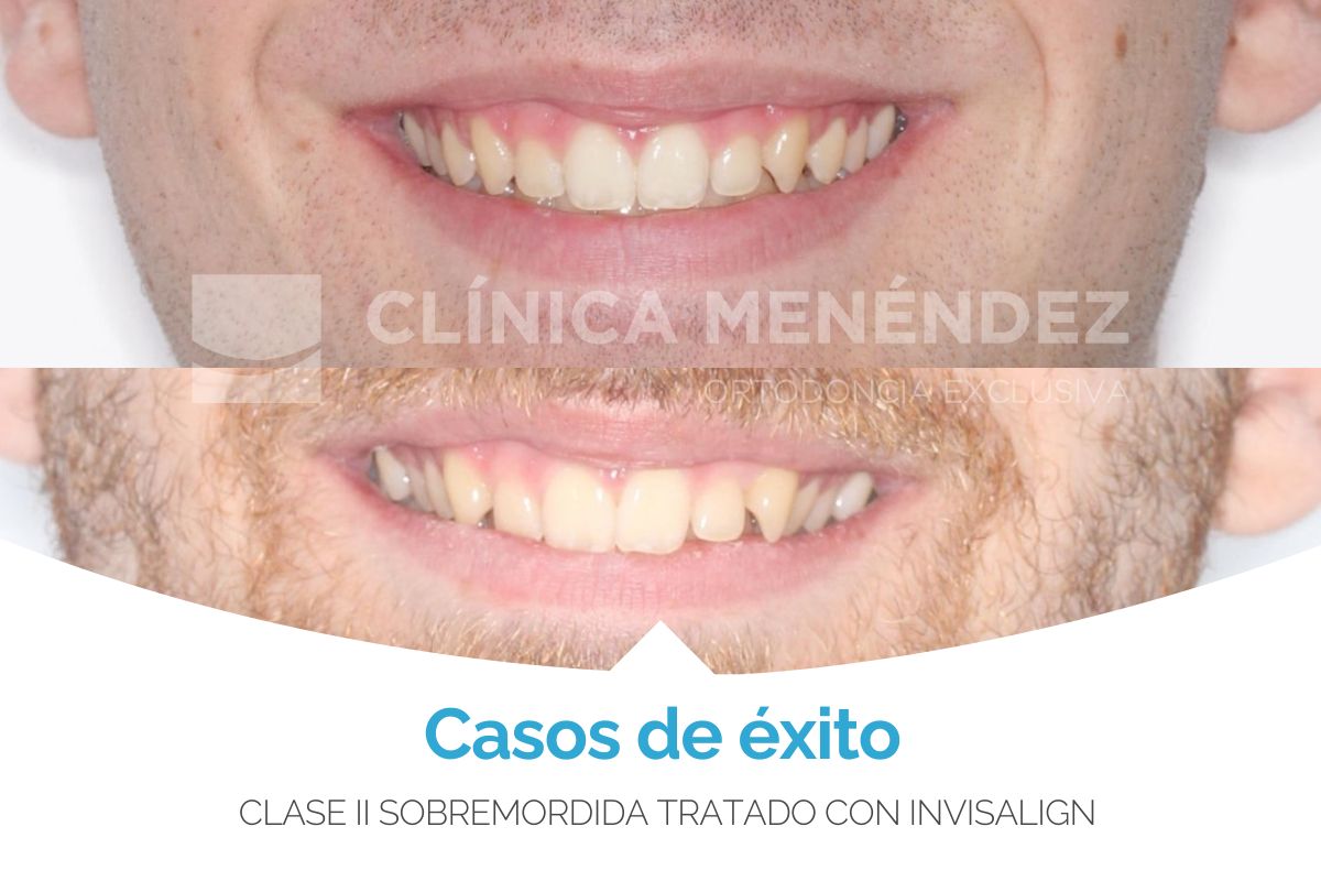 Clase II con sobremordida tratado con Invisalign