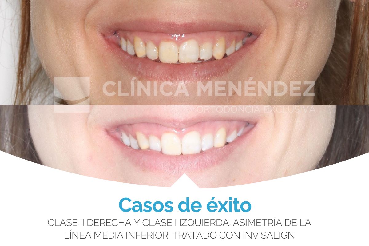 Clase II derecho y clase I izquierda asimetría de la línea media inferior tratado con Invisalign