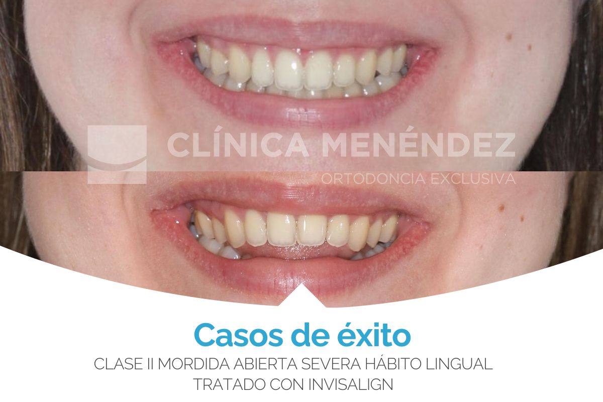 Clase II mordida abierta severa por hábito lingual tratado con Invisalign