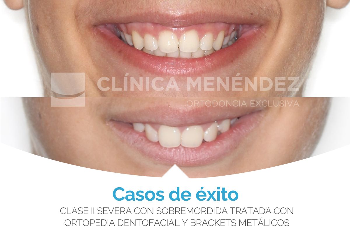 Clase II severa con sobremordida tratada con ortopedia dentofacial + brackets metálicos