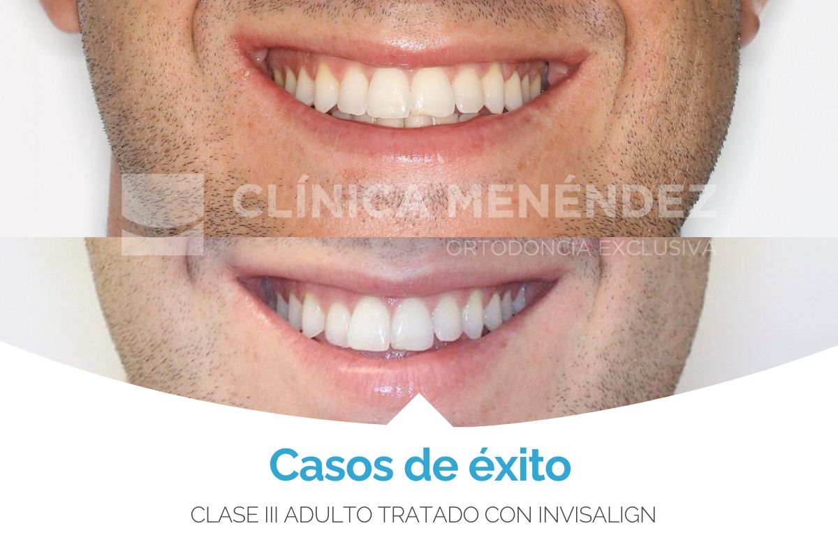 Clase III adulto tratado con Invisalign