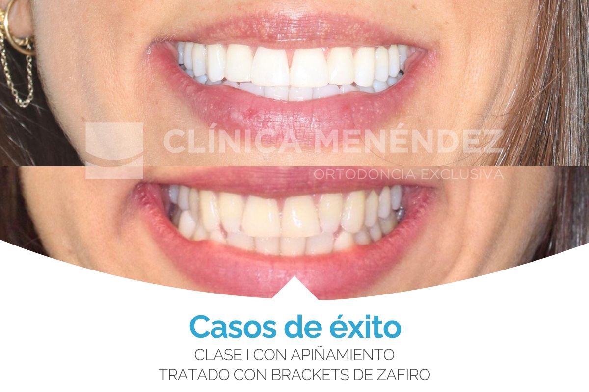 Clase III con microdoncia de incisivos laterales superiores tratada con Invisalign + estética dental