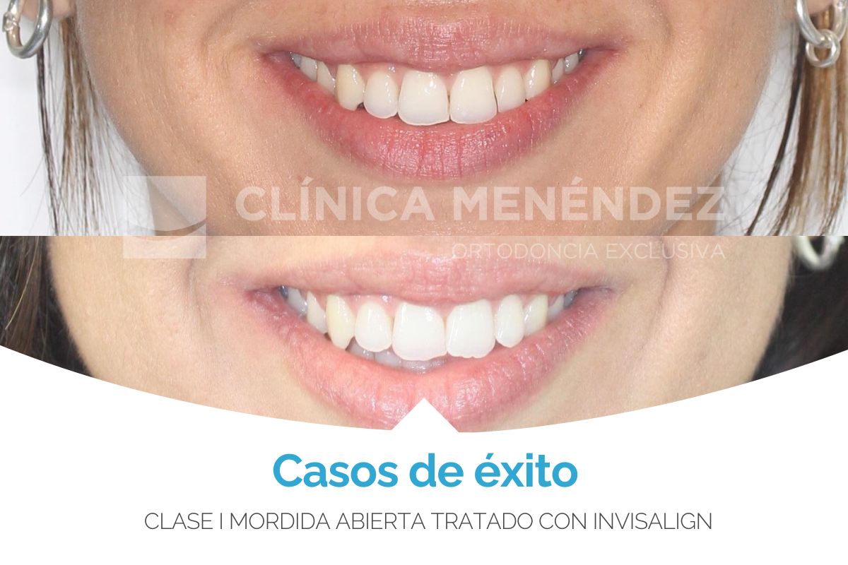 clase 1 mordida abierta tratado con invisalign