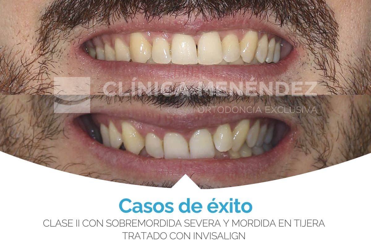 clase 2 sobremordida severa mordida tijera invisalign min