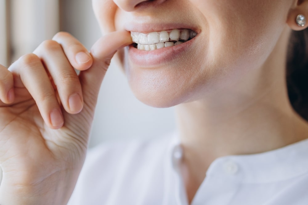 ataches invisalign ortodoncia invisible